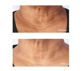 Perricone Cold Plasma Crema Cuello 59 ml