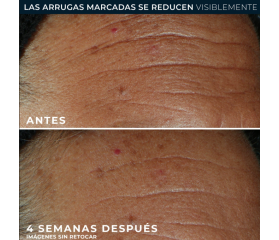 ROC Derm Correxion Targeted Solutions Fill + Treat Sérum